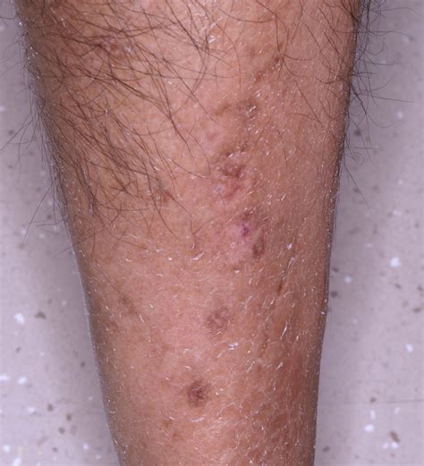 diabetic dermopathy photos|diabetes dry skin on legs.